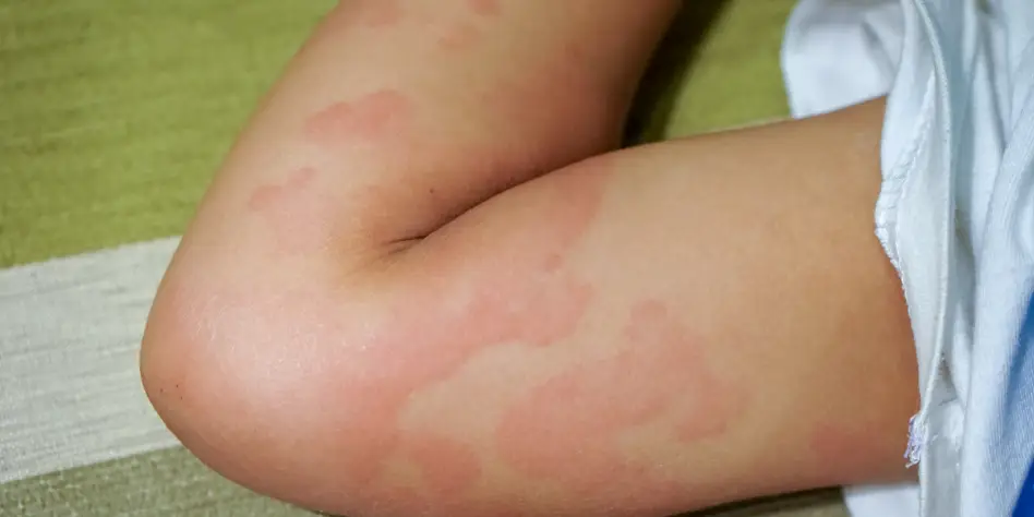 Can amoxicillin cause allergic reactions?